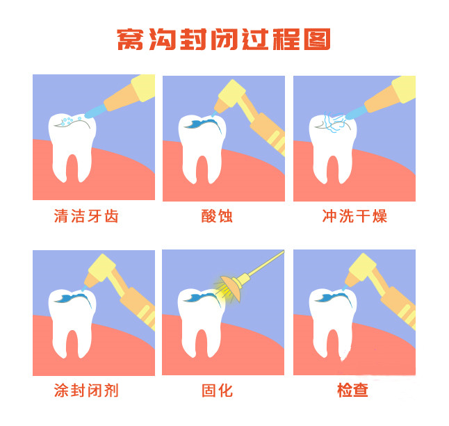 窩溝封閉過程圖